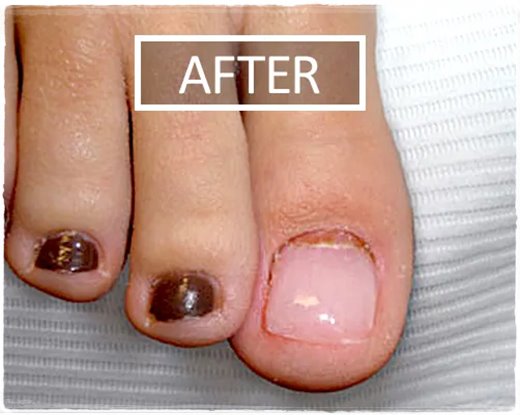 nail fungus after relief