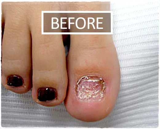 nail fungus before relief